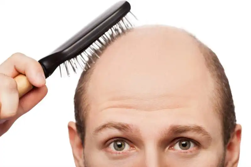 alopecie homme definition